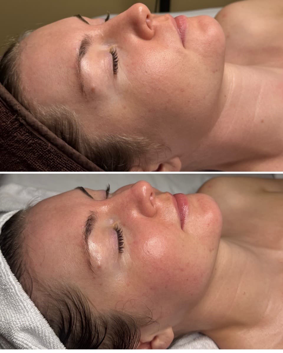 Before and after a lymphatic drainage facial showing a calmer, less puffy face at THE ONE Clinic in Austin