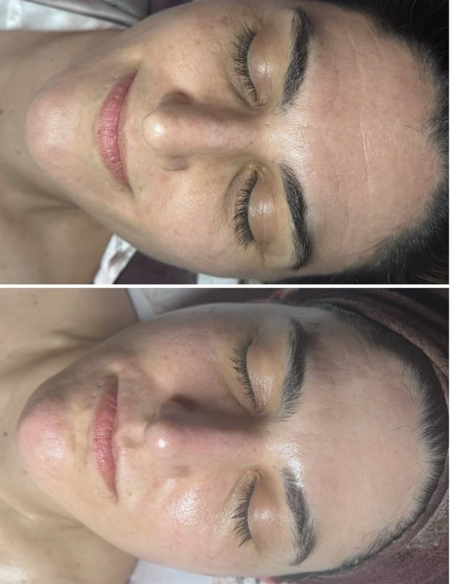 Before and after a SculptONE lifting facial at THE ONE Clinic in Austin