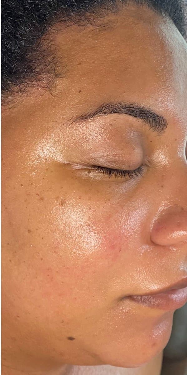 A THE ONE Clinic client after a SculptONE facial