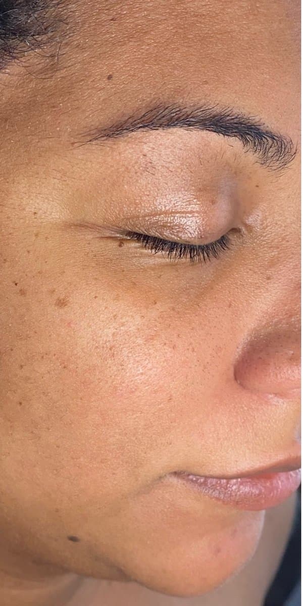 A THE ONE Clinic client before a SculptONE facial