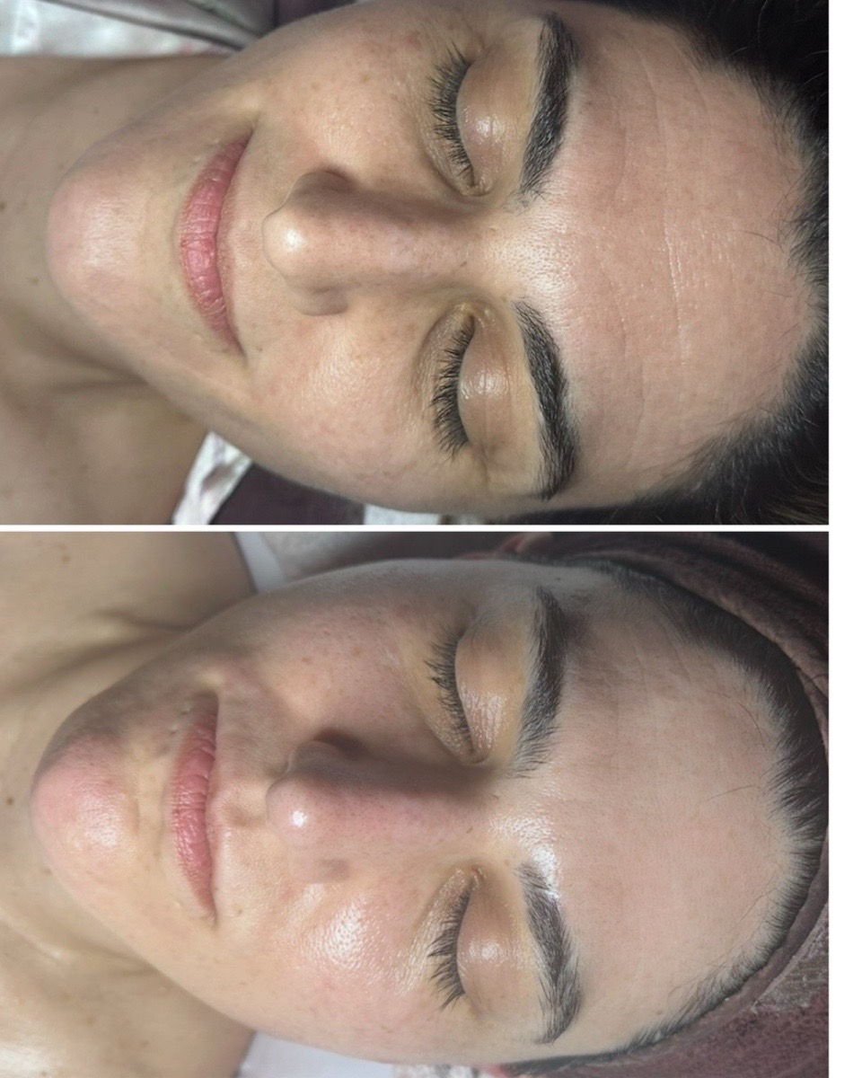 Before and after a SculptONE lifting facial at THE ONE Clinic in Austin