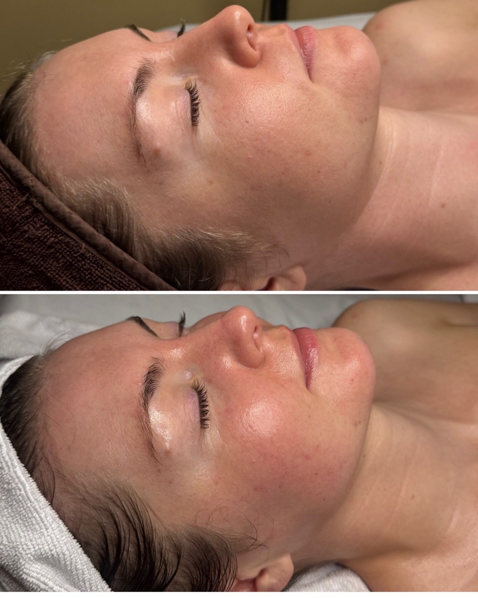 Before and after a lymphatic drainage facial showing a calmer, less puffy face at THE ONE Clinic in Austin